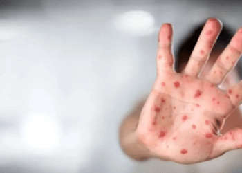 Alertă de rujeolă: 4 cazuri confirmate la copii, alți 4 suspecți