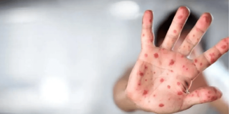 Alertă de rujeolă: 4 cazuri confirmate la copii, alți 4 suspecți