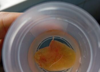 Гриб в носу: жительница Подмосковья два года не могла дышать