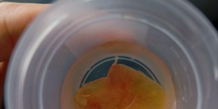 Гриб в носу: жительница Подмосковья два года не могла дышать