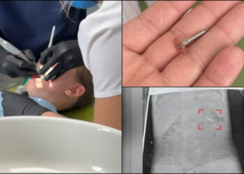 Scandal la o clinică stomatologică din Iaşi. Medicul i-a scăpat unui copil de 5 ani o freză pe gât