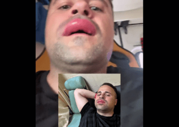 Incident la piscină: fost procuror a ajuns la spital după o înțepătură de albină