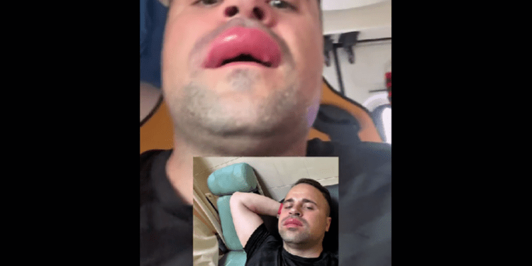 Incident la piscină: fost procuror a ajuns la spital după o înțepătură de albină