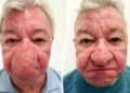 Nasul îi acoperea jumătate din față. Nu putea să bea dintr-un pahar sau să-și sărute soția. Operația care i-a schimbat viața unui pensionar