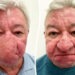 Nasul îi acoperea jumătate din față. Nu putea să bea dintr-un pahar sau să-și sărute soția. Operația care i-a schimbat viața unui pensionar