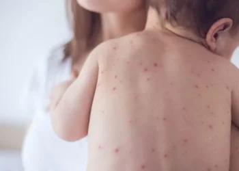 Autoritățile raportează un caz de rujeolă înregistrat în capitală