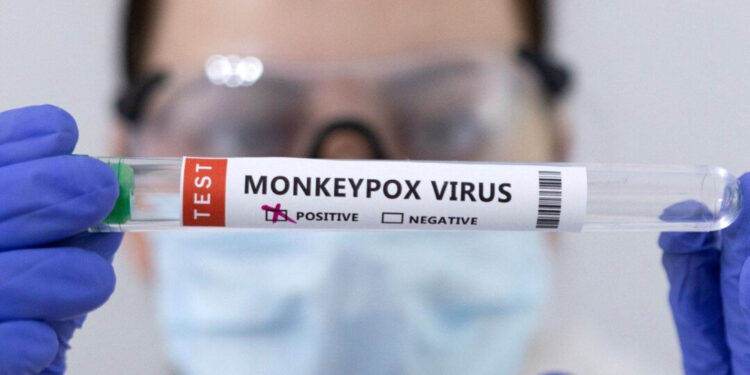 В Молдове выявлен завозной случай оспы обезьян